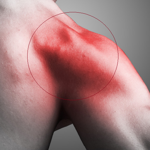 Rotator Cuff Tear Exercises Rotator Cuff Tear Exercises