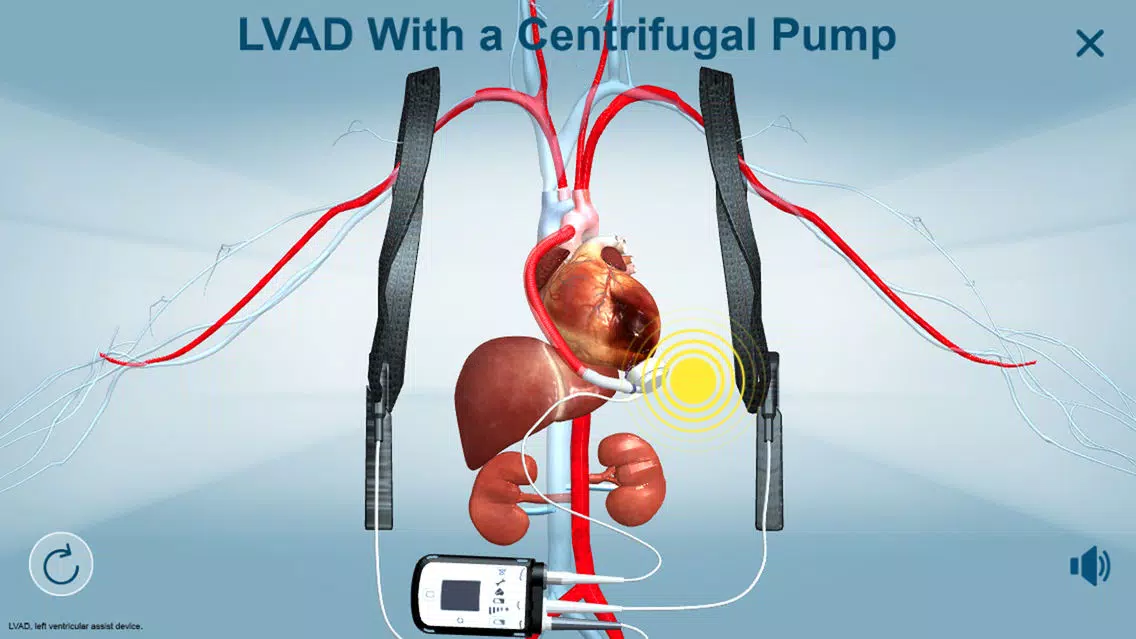 Ảnh chụp màn hình của HeartMate 3™ LVAD AR app