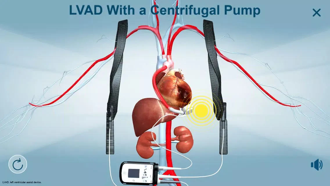 HeartMate 3™ LVAD AR app स्क्रीनशॉट