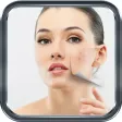 Acne No Mas: Consejos Para Eliminar Acne Del Todo