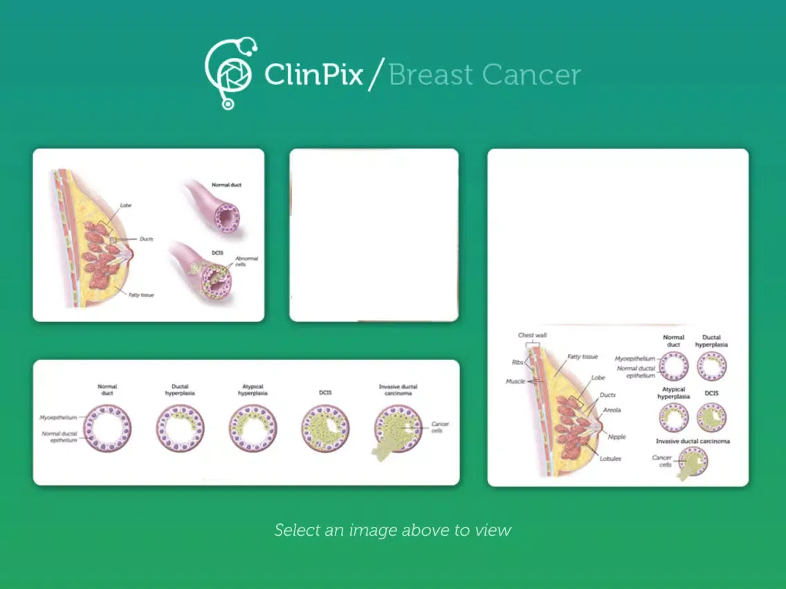 ClinPix: Breast Cancer iPad 应用截图