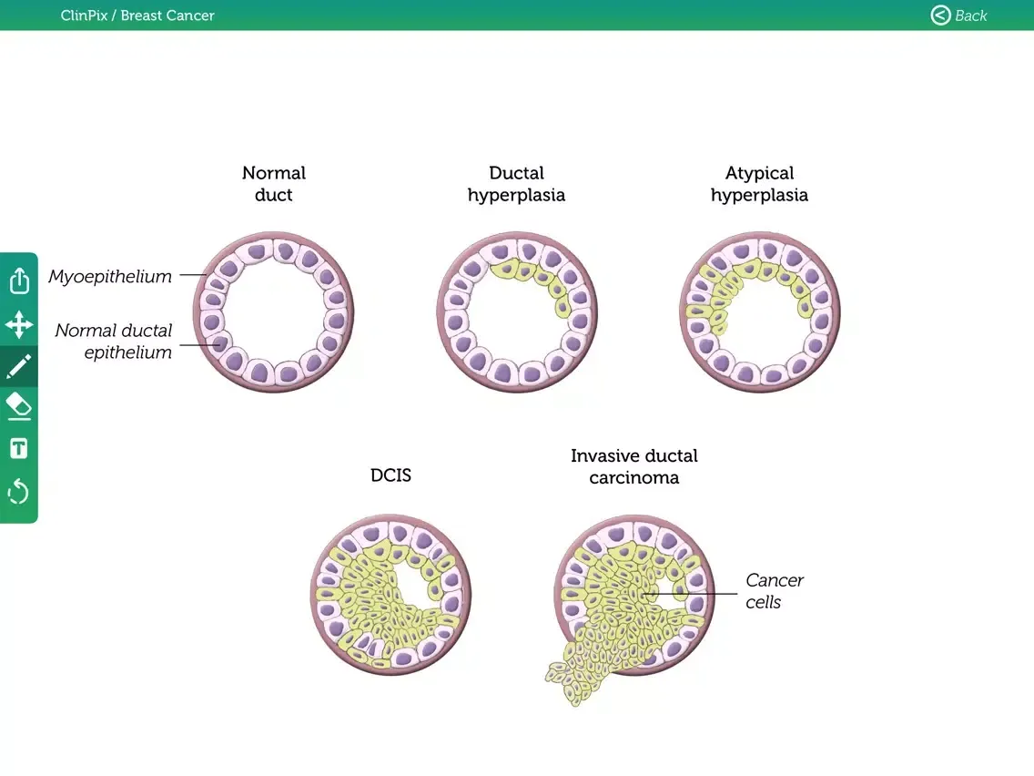 ClinPix: Breast Cancer iPad 应用截图