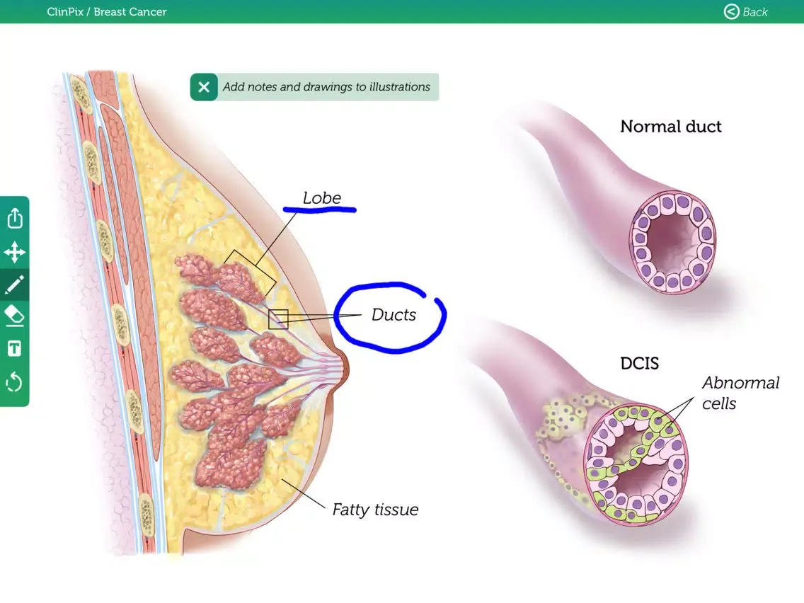 ClinPix: Breast Cancer iPad 应用截图