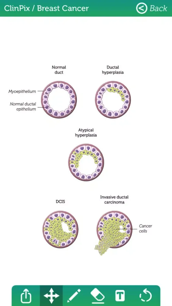 ClinPix: Breast Cancer应用截图