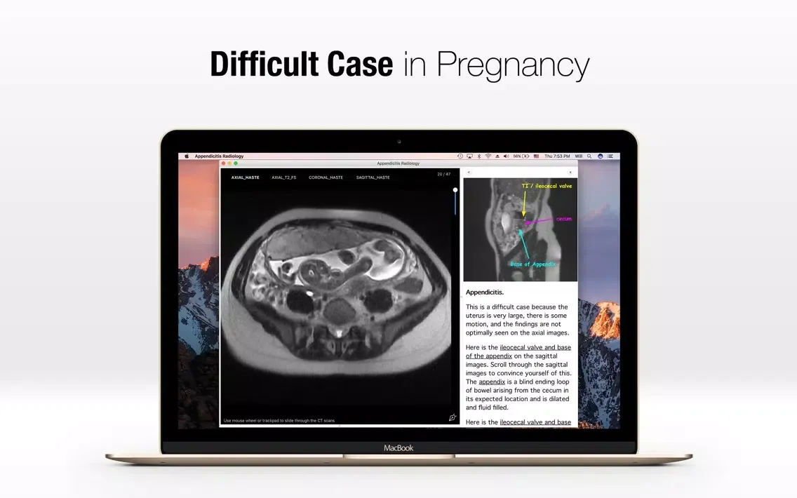 Tangkapan skrin Appendicitis Radiology