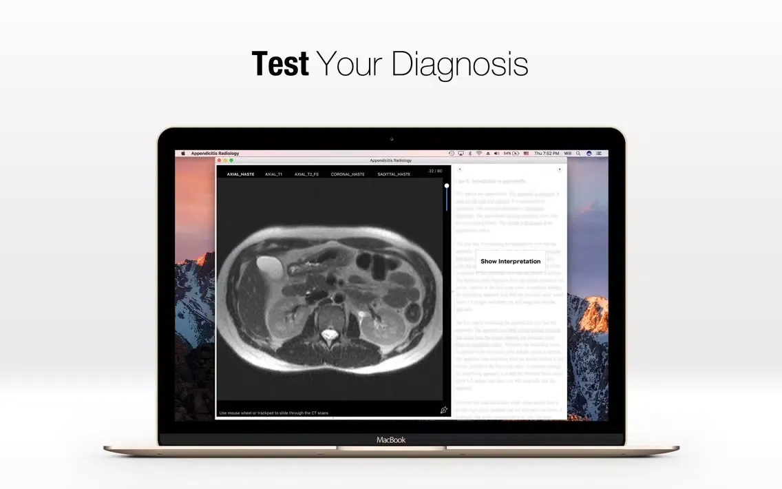 Tangkapan skrin Appendicitis Radiology