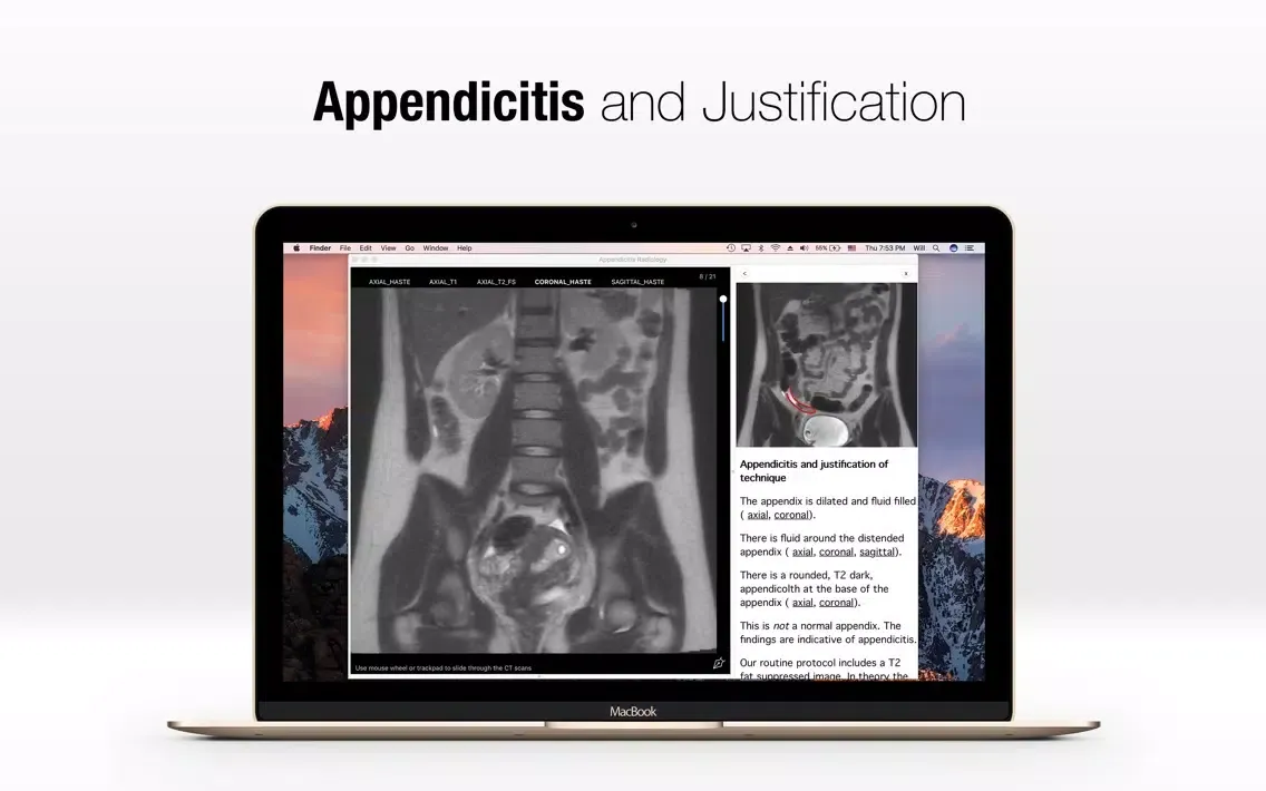 Tangkapan skrin Appendicitis Radiology