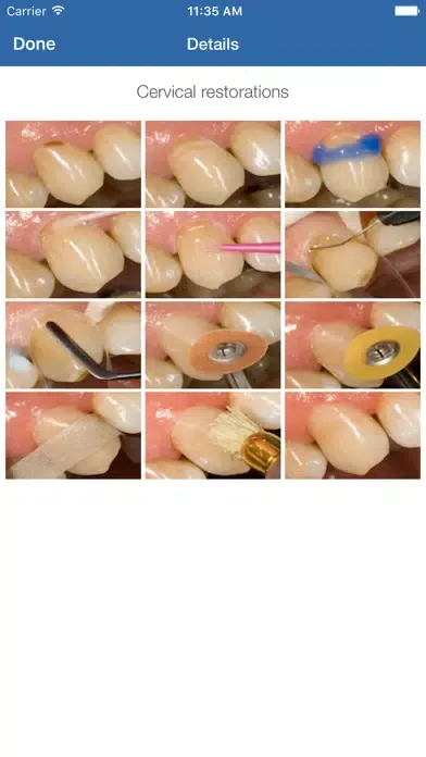 تصاویر Dental Composite