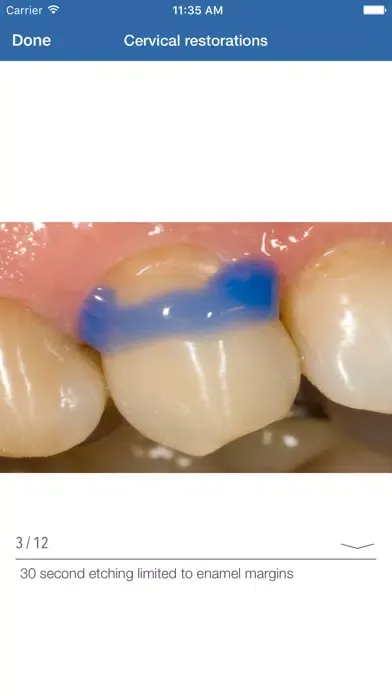تصاویر Dental Composite