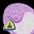Ovarian Tumor Pathology Ovarian Tumor Pathology