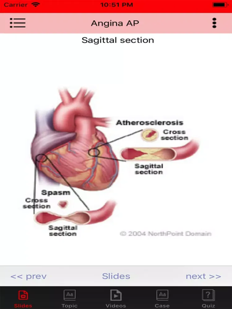 Angina offline iPad  Screenshots